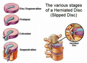 stages of disc herniation